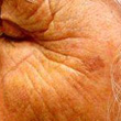 Prematurely-Ageing Skin