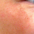 Pigmentation
