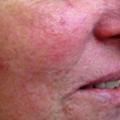Sensitive Skin